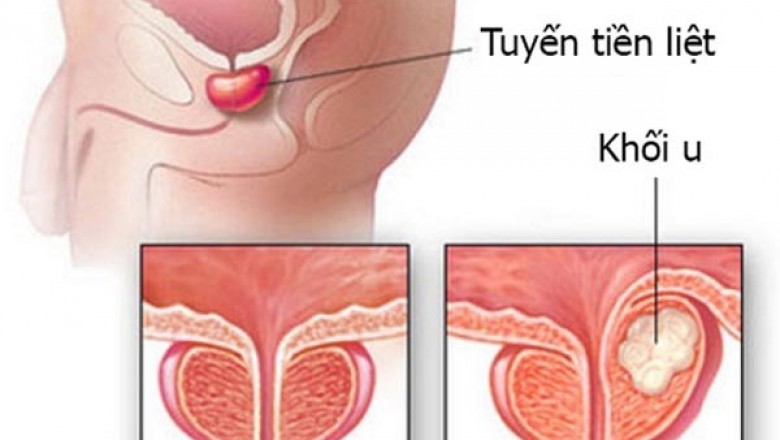 Dấu hiệu cảnh báo bạn bị ung thư tuyến tiền liệt