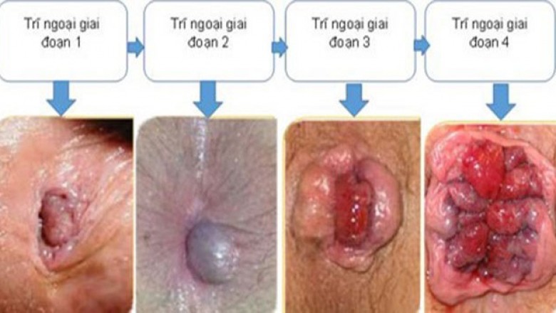 Nhận biết dấu hiệu bệnh trĩ ở trẻ em và các phương hướng điều trị tốt nhất