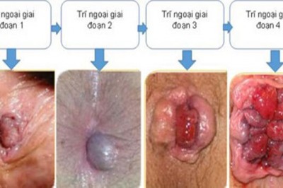 Nhận biết dấu hiệu bệnh trĩ ở trẻ em và các phương hướng điều trị tốt nhất