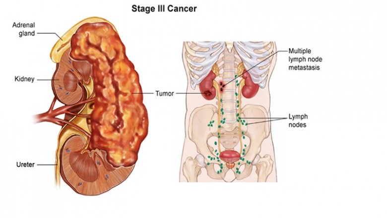 Những dấu hiệu nhận biết có thể bạn bị bệnh ung thư thận