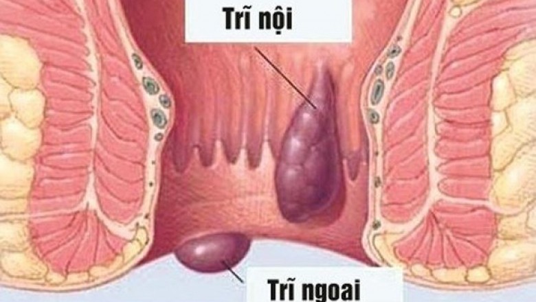 Người bị bệnh trĩ nên kiêng ăn gì?