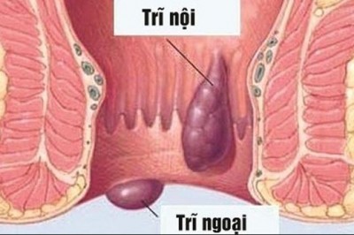 Người bị bệnh trĩ nên kiêng ăn gì?