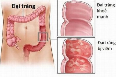 Bài thuốc hay chữa bệnh viêm đại tràng