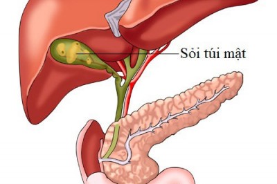 Sỏi mật, Triệu chứng, nguyên nhân, điều trị, phòng ngữa bệnh sỏi túi mật