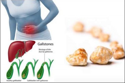 Cách điều trị bệnh sỏi túi mật hiệu quả