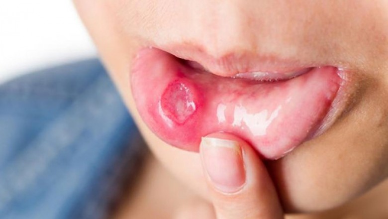 Các triệu chứng và cách phòng tránh Bệnh Ung thư miệng