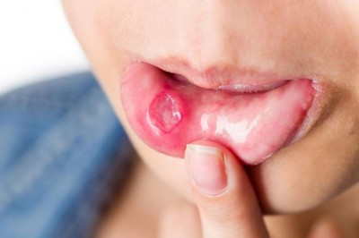 Các triệu chứng và cách phòng tránh Bệnh Ung thư miệng