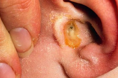 Bài thuốc hay chữa viêm tai giữa theo Lương y Nguyễn Minh