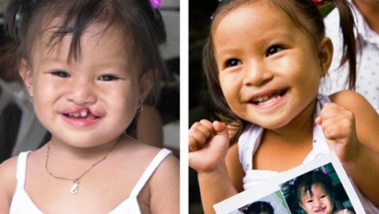 Chia sẻ: Caritas Sài Gòn tổ chức chương trình mổ sứt môi, hở hàm ếch cho trẻ em nghèo