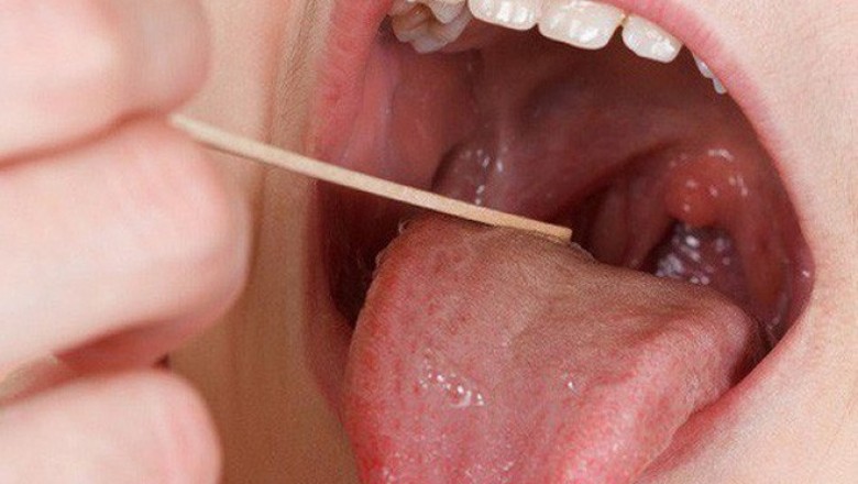 Những dấu hiệu cảnh báo sớm bạn bị ung thư lưỡi