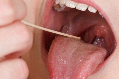 Những dấu hiệu cảnh báo sớm bạn bị ung thư lưỡi