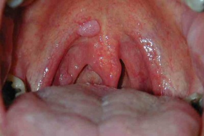 Dấu hiệu cảnh báo ung thư tai mũi họng