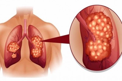 Cách dùng thảo dược, Món ăn bài thuốc chữa ung thư phổi