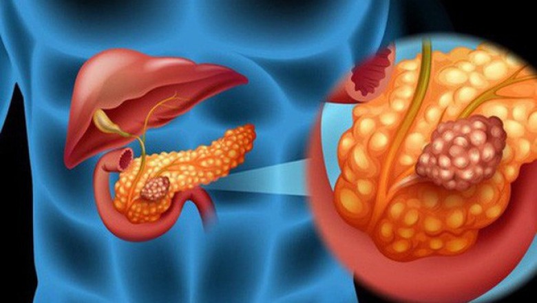 Dấu hiệu nhận biết bệnh ung thư tụy là gì?