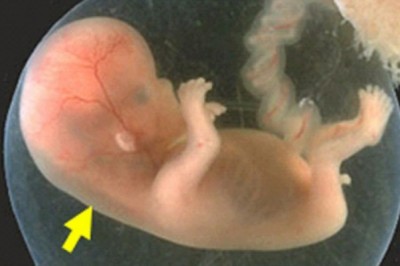 Độ mờ da gáy thai nhi bao nhiêu cảnh báo bé bị Down