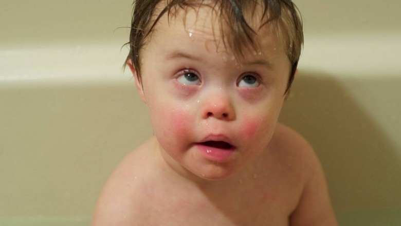 Những điều cần biết về hội chứng Down ở trẻ em