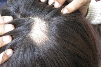 Nguyên nhân thực sự của bệnh rụng tóc nhiều người đang mắc phải