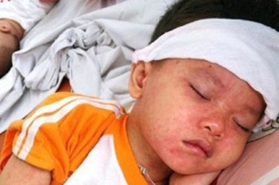 Tại sao virus sởi lại đặc biệt nguy hiểm cho trẻ sơ sinh?