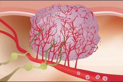 Bài nói chuyện của bác sĩ William Li về ung thư rất hay