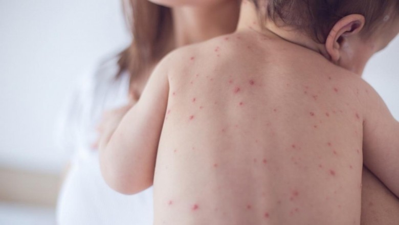 Bệnh sởi tăng cao trên thế giới những tháng đầu năm 2019