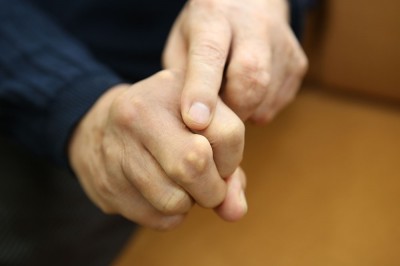 Triệu chứng, nguyên nhân, điều trị, phòng ngừa bệnh Gout