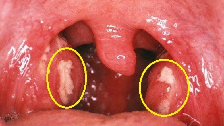 Nguyên nhân, triệu chứng và cách điều trị bệnh Viêm amidan