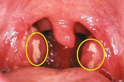 Nguyên nhân, triệu chứng và cách điều trị bệnh Viêm amidan
