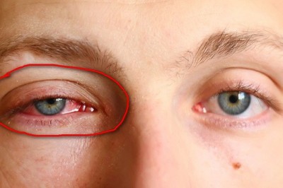 Bài thuốc chữa đau mắt đỏ