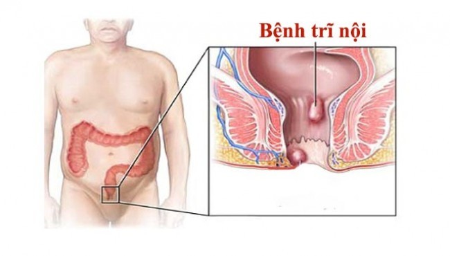 Bài thuốc đông y hay chữa trị trĩ hiệu quả an toàn