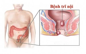 Bài thuốc đông y hay chữa trị trĩ hiệu quả an toàn