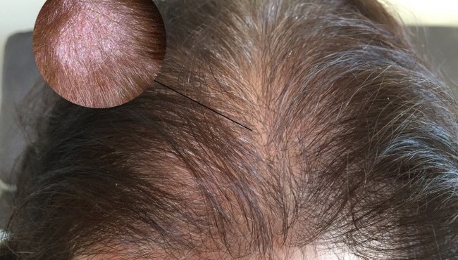 Món ăn, bài thuốc từ thảo dược trị rụng tóc