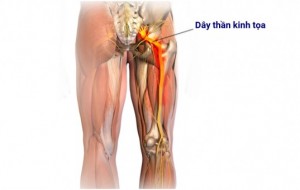Bài thuốc đông y trị bệnh đau dây thần kinh tọa hiệu quả
