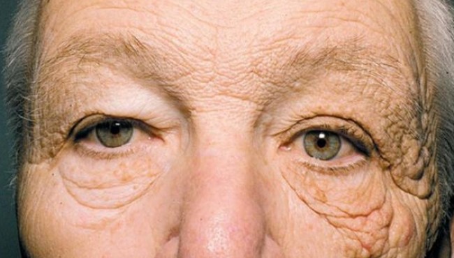 Nhược cơ là bệnh gì?