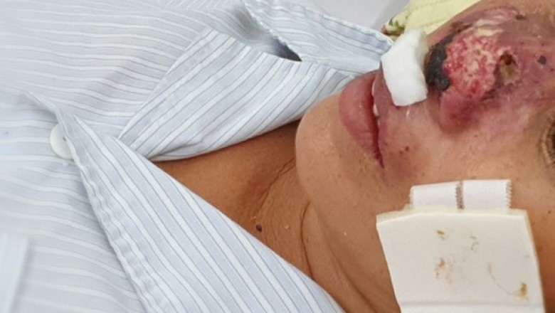 Hàng chục người nhập viện Bạch Mai do nhiễm vi khuẩn ăn thịt người