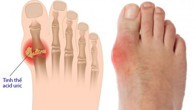 Đàn ông bị bệnh gút nên ăn gì?