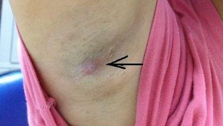 Nổi hạch nách là dấu hiệu bệnh gì?