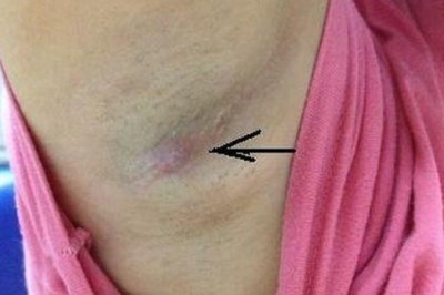 Nổi hạch nách là dấu hiệu bệnh gì?