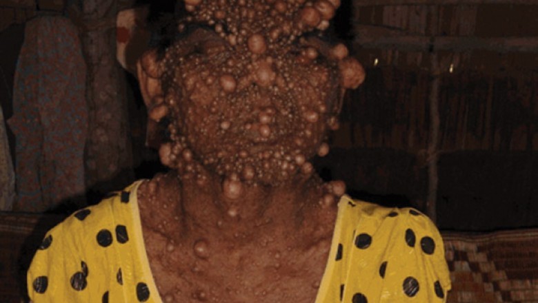 Những cơ thể biến dạng vì u sợi thần kinh