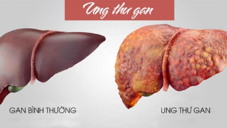 10 dấu hiệu cảnh báo ung thư gan