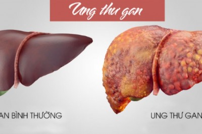 10 dấu hiệu cảnh báo ung thư gan