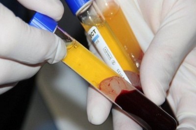 Huyết tương của người khỏi bệnh có thể diệt Virus Corona