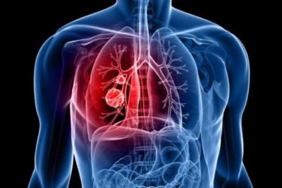 Phát triển phương pháp mới chữa ung thư phổi