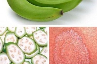 Nhựa quả chuối xanh có trị được giời leo?