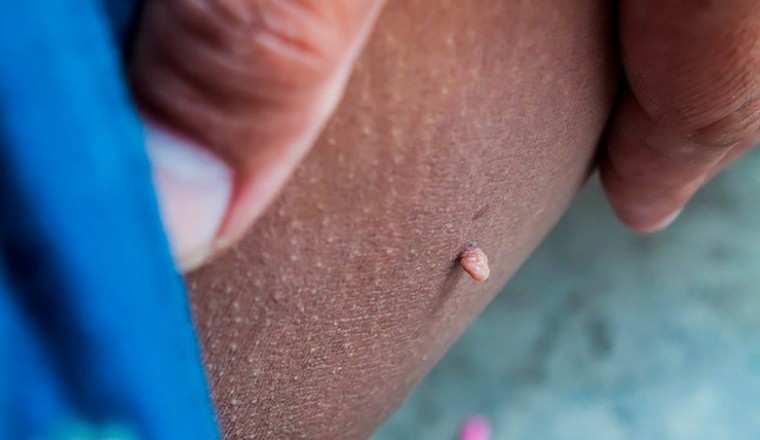 Mụn thịt trên da có nguy hiểm không, loại bỏ thế nào?