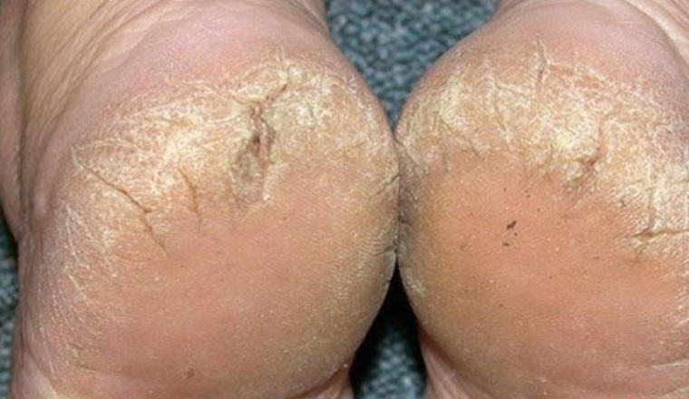 Những nguyên nhân gây ra bệnh nứt nẻ gót chân ít người biết