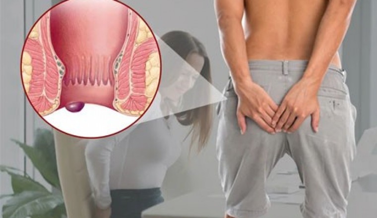 Người bệnh trĩ nên hạn chế ăn các loại thực phẩm nào?