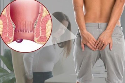 Người bệnh trĩ nên hạn chế ăn các loại thực phẩm nào?