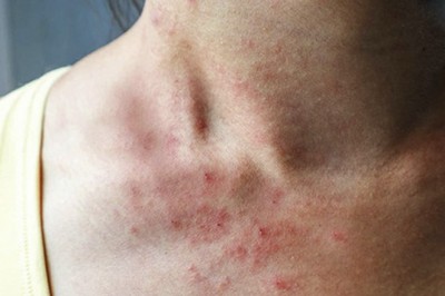 5 loại thực phẩm gây viêm nhiễm cho cơ thể