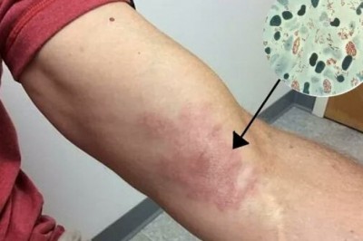 Bệnh phong có lây không?