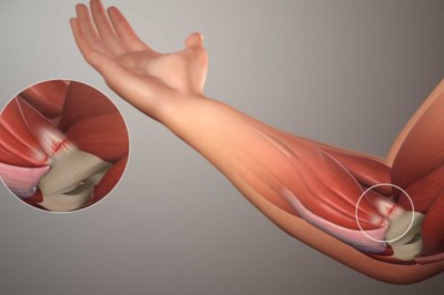 Đau khớp khuỷu tay: Nguyên nhân và cách xử trí